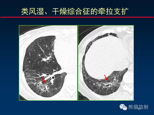 【PPT】肺内间质改变的基本CT征象