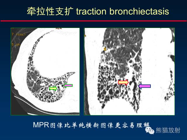 【PPT】肺内间质改变的基本CT征象