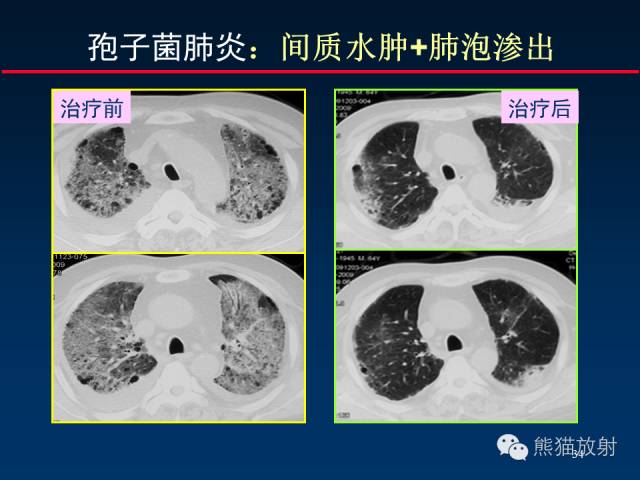 【PPT】肺内间质改变的基本CT征象