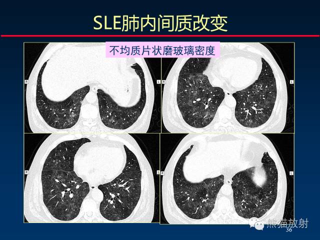 【PPT】肺内间质改变的基本CT征象