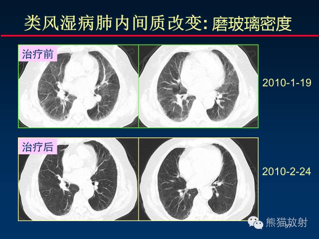 【PPT】肺内间质改变的基本CT征象