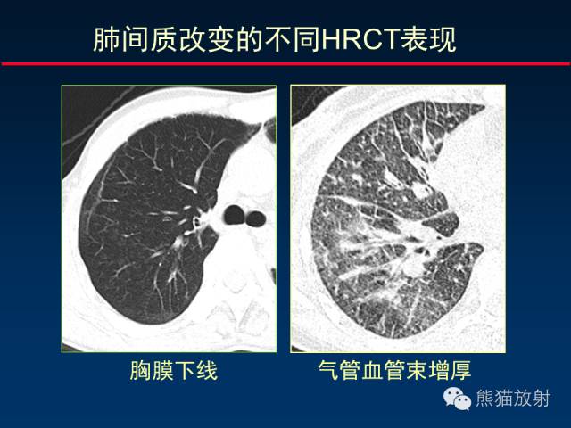 【PPT】肺内间质改变的基本CT征象