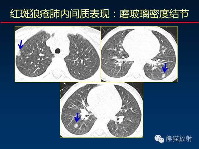 【PPT】肺内间质改变的基本CT征象