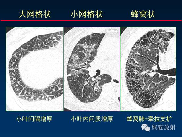 【PPT】肺内间质改变的基本CT征象