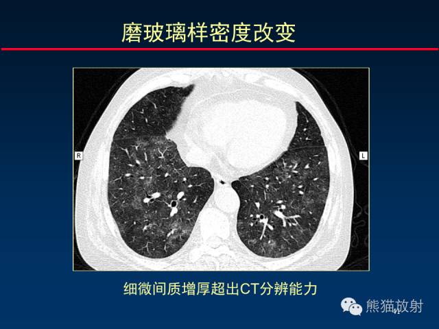 【PPT】肺内间质改变的基本CT征象