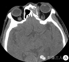 【病例】左侧额窦筛窦非霍奇金淋巴瘤1例CT影像表现分析