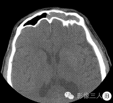 【病例】左侧额窦筛窦非霍奇金淋巴瘤1例CT影像表现分析