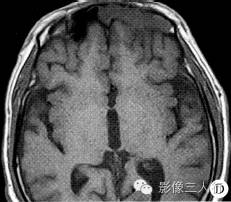 【病例】左侧额窦筛窦非霍奇金淋巴瘤1例CT影像表现分析