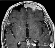 【病例】左侧额窦筛窦非霍奇金淋巴瘤1例CT影像表现分析