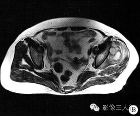【病例】左臀部软组织脓肿1例MR影像表现分析
