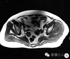 【病例】左臀部软组织脓肿1例MR影像表现分析