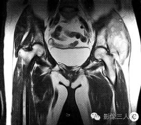 【病例】左臀部软组织脓肿1例MR影像表现分析