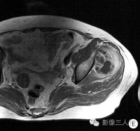 【病例】左臀部软组织脓肿1例MR影像表现分析