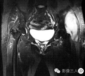【病例】左臀部软组织脓肿1例MR影像表现分析