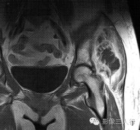 【病例】左臀部软组织脓肿1例MR影像表现分析