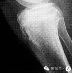 【病例】右胫骨骨骺软骨母细胞瘤1例CT及MR影像表现分析 【病例】右胫骨骨骺软骨母细胞瘤1例CT及MR影像表现分析
