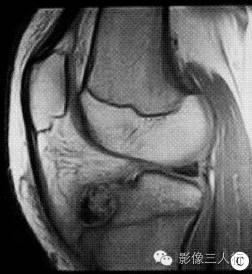【病例】右胫骨骨骺软骨母细胞瘤1例CT及MR影像表现分析 【病例】右胫骨骨骺软骨母细胞瘤1例CT及MR影像表现分析