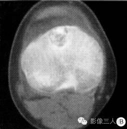 【病例】右胫骨骨骺软骨母细胞瘤1例CT及MR影像表现分析