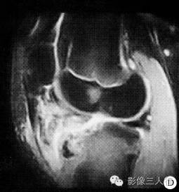 【病例】右胫骨骨骺软骨母细胞瘤1例CT及MR影像表现分析 【病例】右胫骨骨骺软骨母细胞瘤1例CT及MR影像表现分析