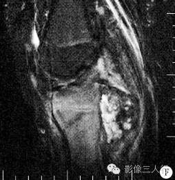 【病例】右胫骨骨骺软骨母细胞瘤1例CT及MR影像表现分析 【病例】右胫骨骨骺软骨母细胞瘤1例CT及MR影像表现分析