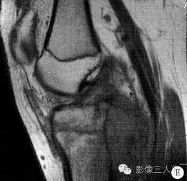 【病例】右胫骨骨骺软骨母细胞瘤1例CT及MR影像表现分析 【病例】右胫骨骨骺软骨母细胞瘤1例CT及MR影像表现分析