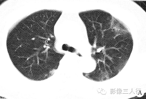 【病例】慢性嗜酸性细胞肺浸润1例CT影像表现分析 【病例】慢性嗜酸性细胞肺浸润1例CT影像表现分析