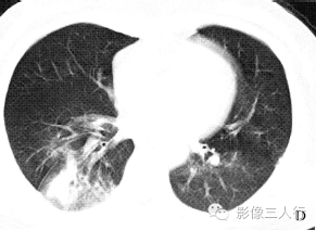 【病例】慢性嗜酸性细胞肺浸润1例CT影像表现分析