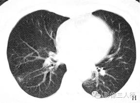 【病例】慢性嗜酸性细胞肺浸润1例CT影像表现分析 【病例】慢性嗜酸性细胞肺浸润1例CT影像表现分析