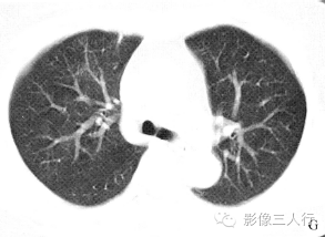 【病例】慢性嗜酸性细胞肺浸润1例CT影像表现分析 【病例】慢性嗜酸性细胞肺浸润1例CT影像表现分析