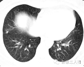 【病例】慢性嗜酸性细胞肺浸润1例CT影像表现分析 【病例】慢性嗜酸性细胞肺浸润1例CT影像表现分析