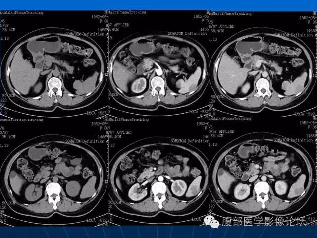 【病例】脾脏硬化性血管瘤样结节性转化1例CT及MR影像表现 【病例】脾脏硬化性血管瘤样结节性转化1例CT及MR影像表现