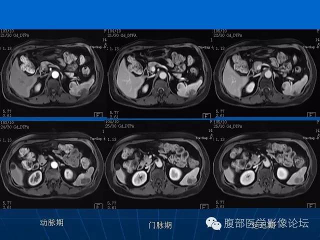 【病例】脾脏硬化性血管瘤样结节性转化1例CT及MR影像表现 【病例】脾脏硬化性血管瘤样结节性转化1例CT及MR影像表现