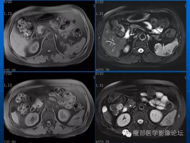 【病例】脾脏硬化性血管瘤样结节性转化1例CT及MR影像表现 【病例】脾脏硬化性血管瘤样结节性转化1例CT及MR影像表现