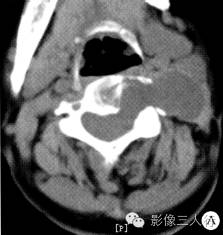 【病例】颈椎椎管内外神经鞘瘤1例MR影像表现分析 【病例】颈椎椎管内外神经鞘瘤1例MR影像表现分析