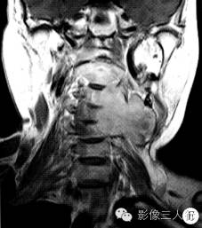 【病例】颈椎椎管内外神经鞘瘤1例MR影像表现分析 【病例】颈椎椎管内外神经鞘瘤1例MR影像表现分析
