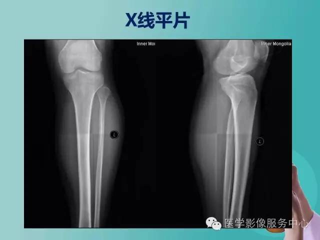 【病例】小腿神经鞘瘤1例CT及MR影像表现