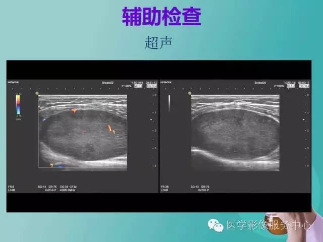 【病例】小腿神经鞘瘤1例CT及MR影像表现