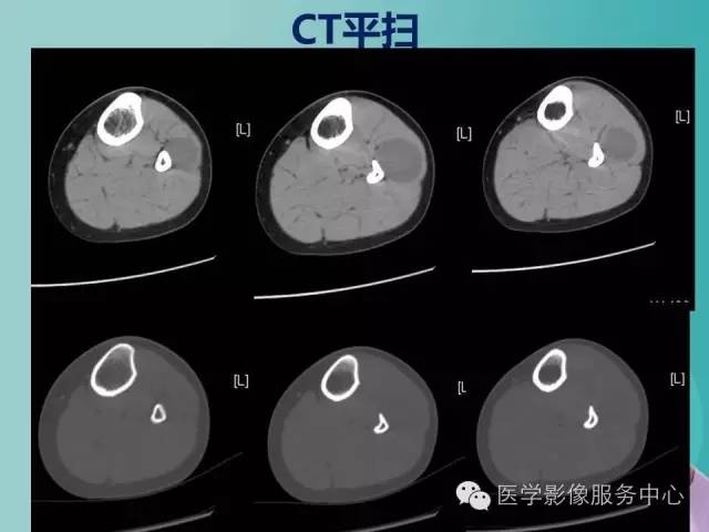 【病例】小腿神经鞘瘤1例CT及MR影像表现