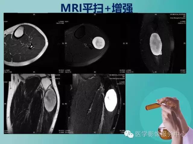 【病例】小腿神经鞘瘤1例CT及MR影像表现