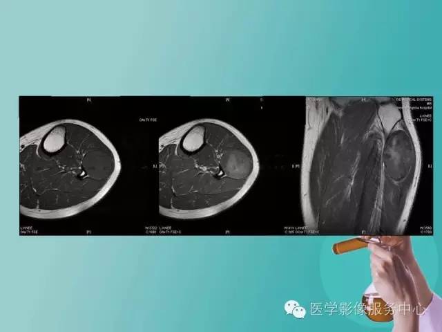 【病例】小腿神经鞘瘤1例CT及MR影像表现