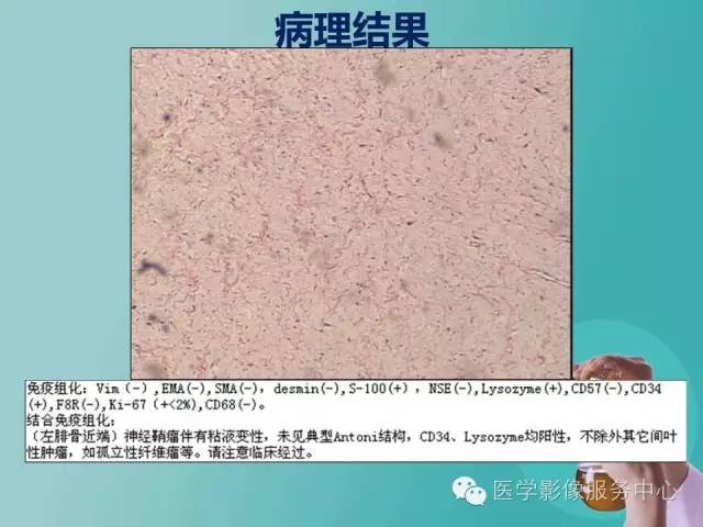 【病例】小腿神经鞘瘤1例CT及MR影像表现