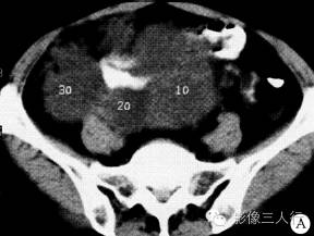 【病例】腹盆腔恶性周围神经鞘膜瘤1例CT影像分析