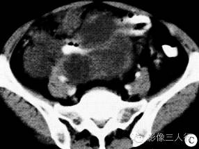 【病例】腹盆腔恶性周围神经鞘膜瘤1例CT影像分析