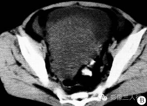 【病例】腹盆腔恶性周围神经鞘膜瘤1例CT影像分析