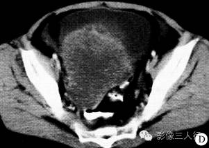 【病例】腹盆腔恶性周围神经鞘膜瘤1例CT影像分析