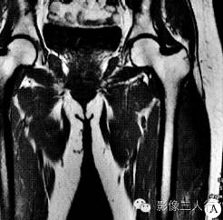 【病例】左大腿滑膜肉瘤1例MR影像表现