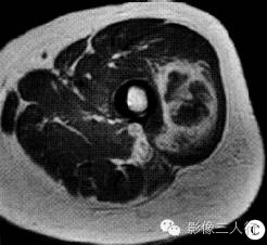 【病例】左大腿滑膜肉瘤1例MR影像表现