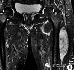【病例】左大腿滑膜肉瘤1例MR影像表现