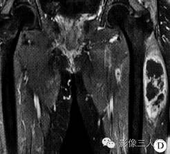 【病例】左大腿滑膜肉瘤1例MR影像表现