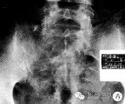 【病例】骶部脊膜瘤侵犯骶骨1例X线CT影像表现分析